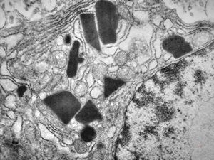 M,59y. | nasopharynx - crystalline inclusions - plasmocytoma